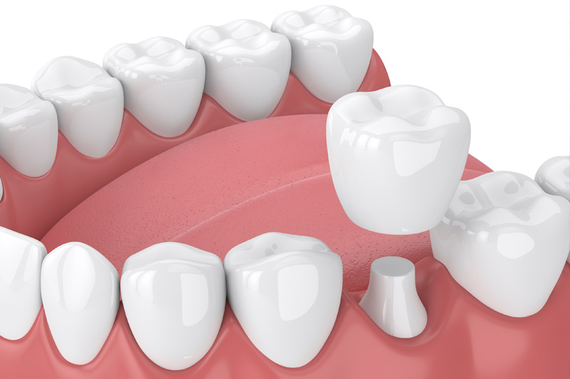 Dental Crowns in Philadelphia